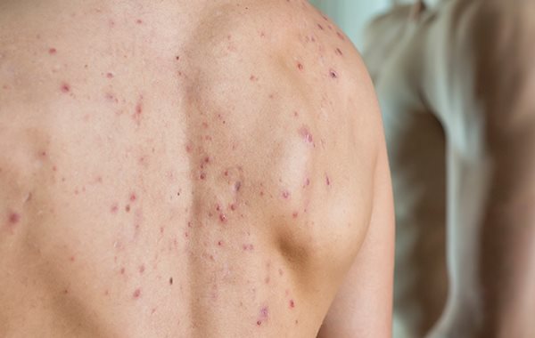 Die verschiedenen Arten von Akne | Akneformen | Eucerin