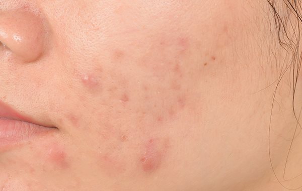 Pickelmale | Folgen von Akne | Eucerin