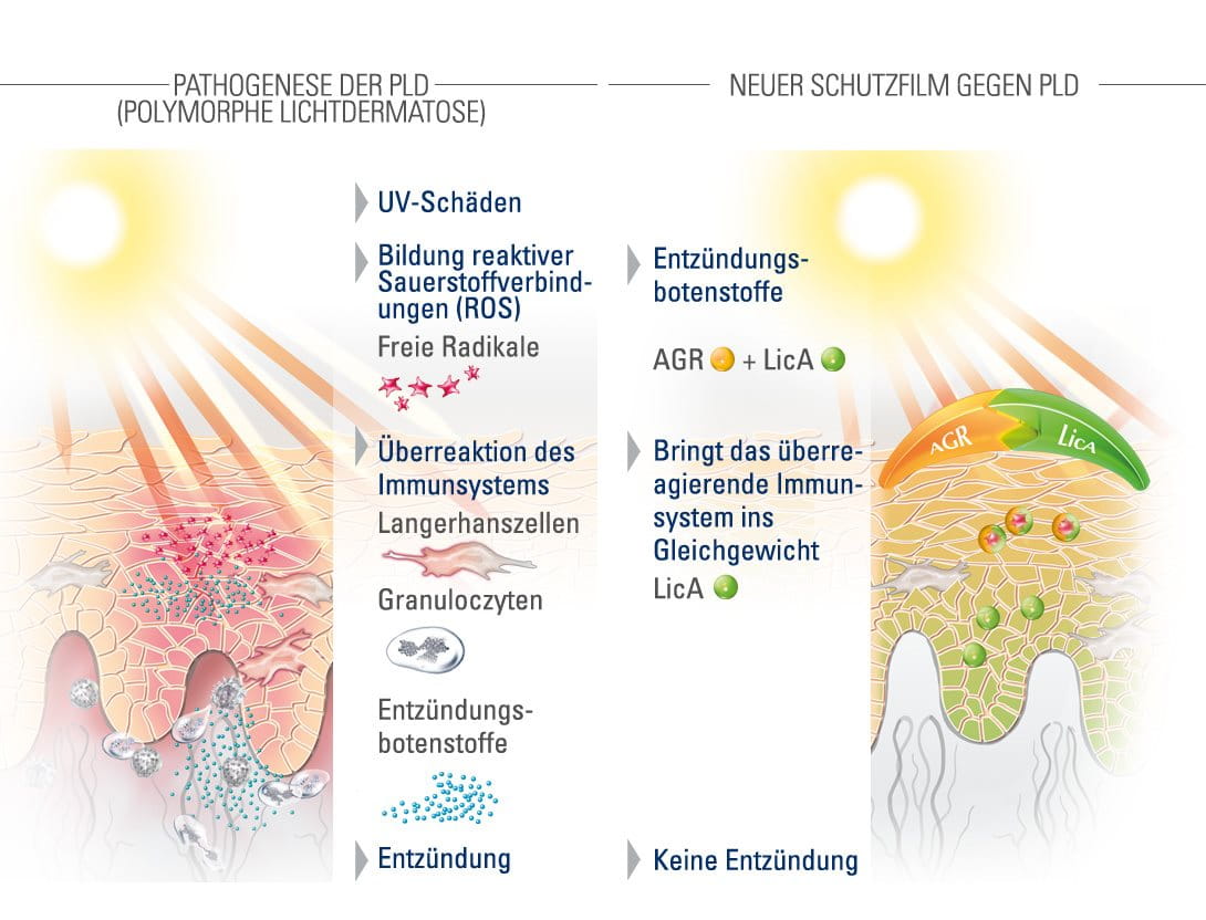 Sonnenallergie Antihistaminika Sonnenallergie Antihistaminika
