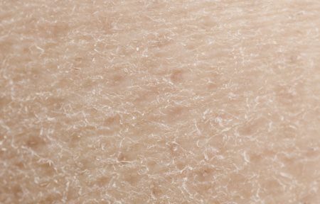 Nahaufnahme trockener Haut