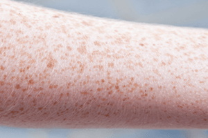 Jeder Hat Das Wundermittel Gegen Besenreiser Im Haus Aber Kaum Jemand Weiss Es Besenreiser Besenreisser Gesundheitstipps